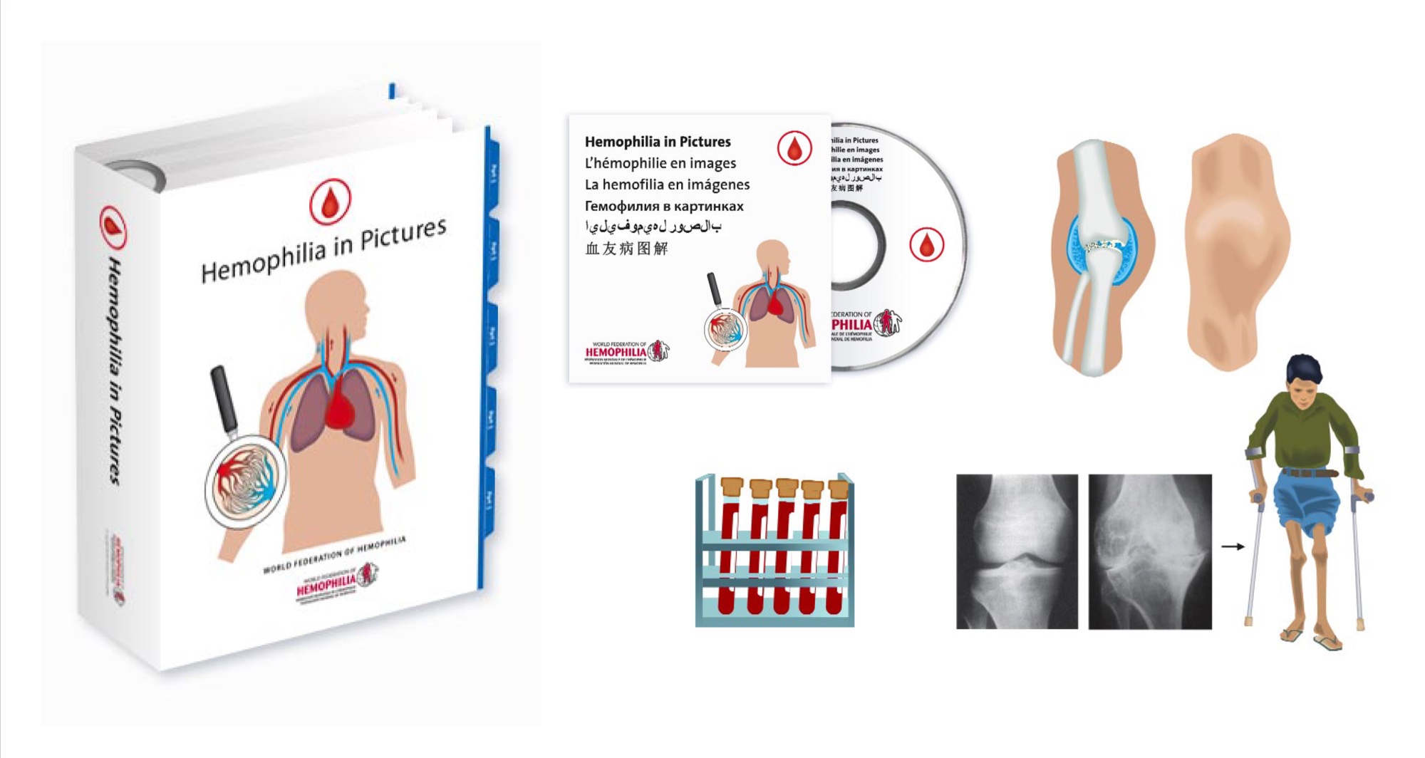 Hemophilia in Pictures page