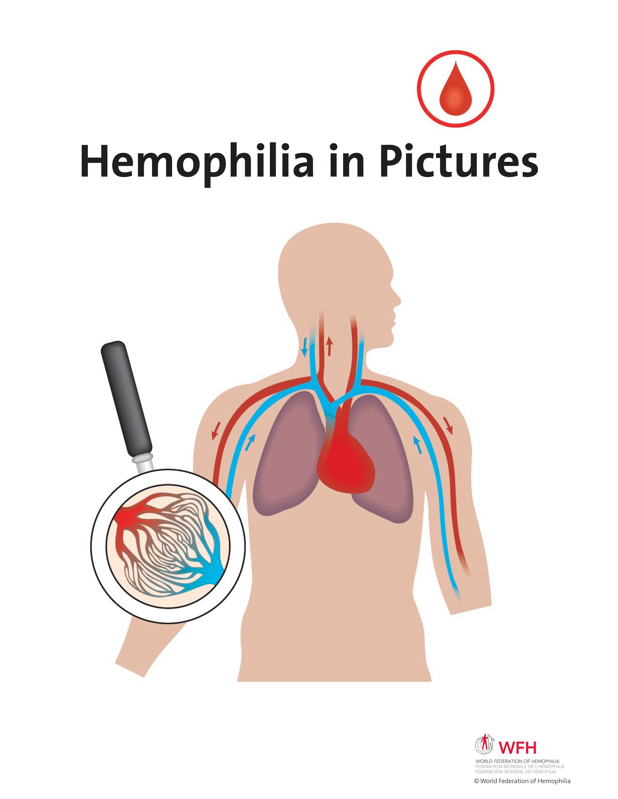 Hemophilia in Pictures spread