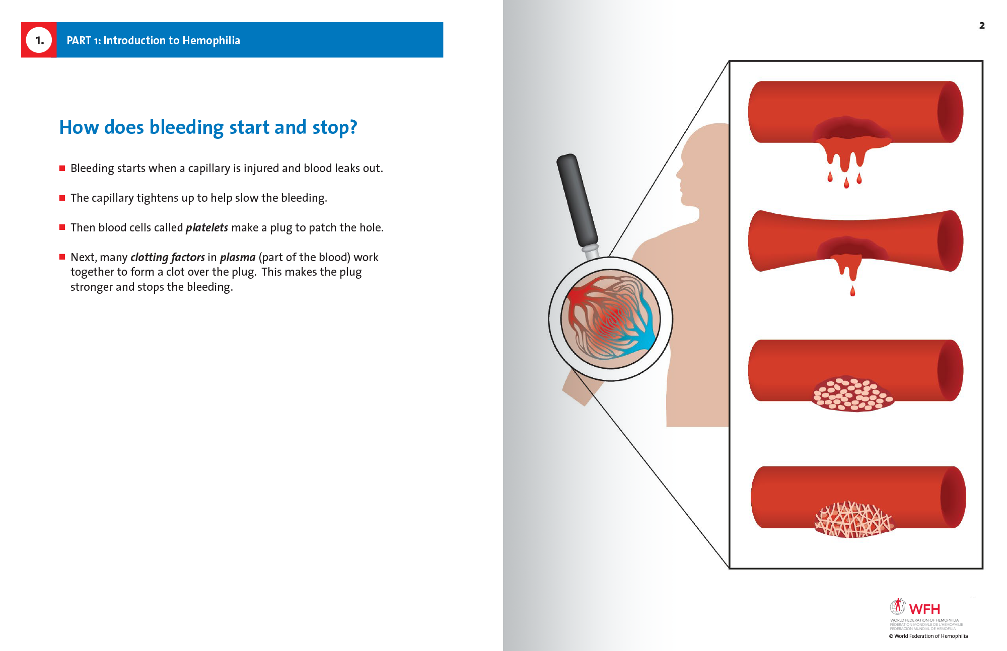 Hemophilia in Pictures spread