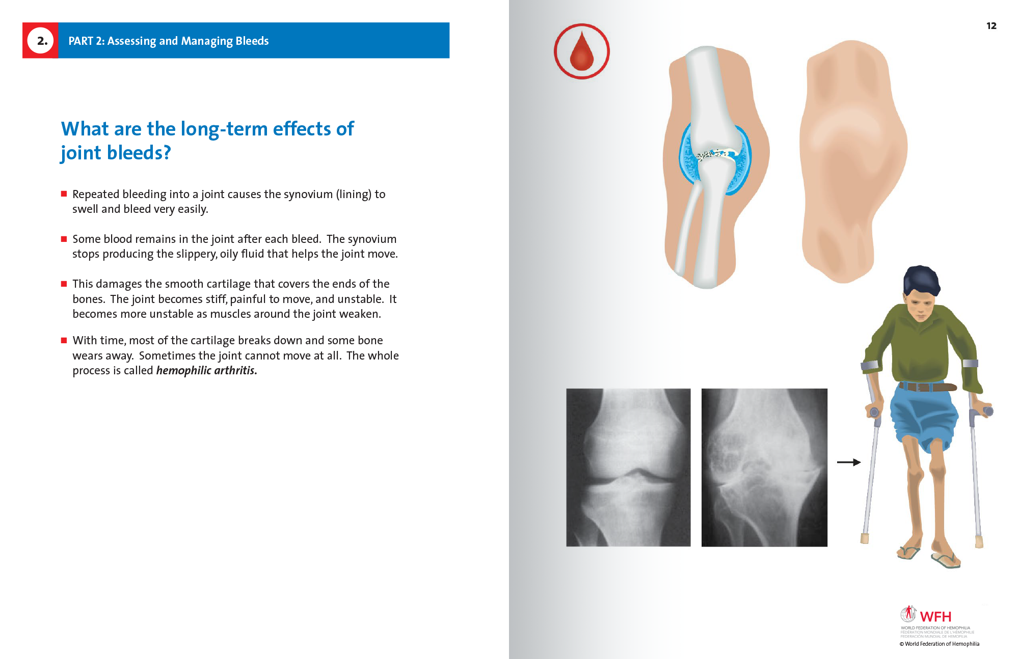 Hemophilia in Pictures spread