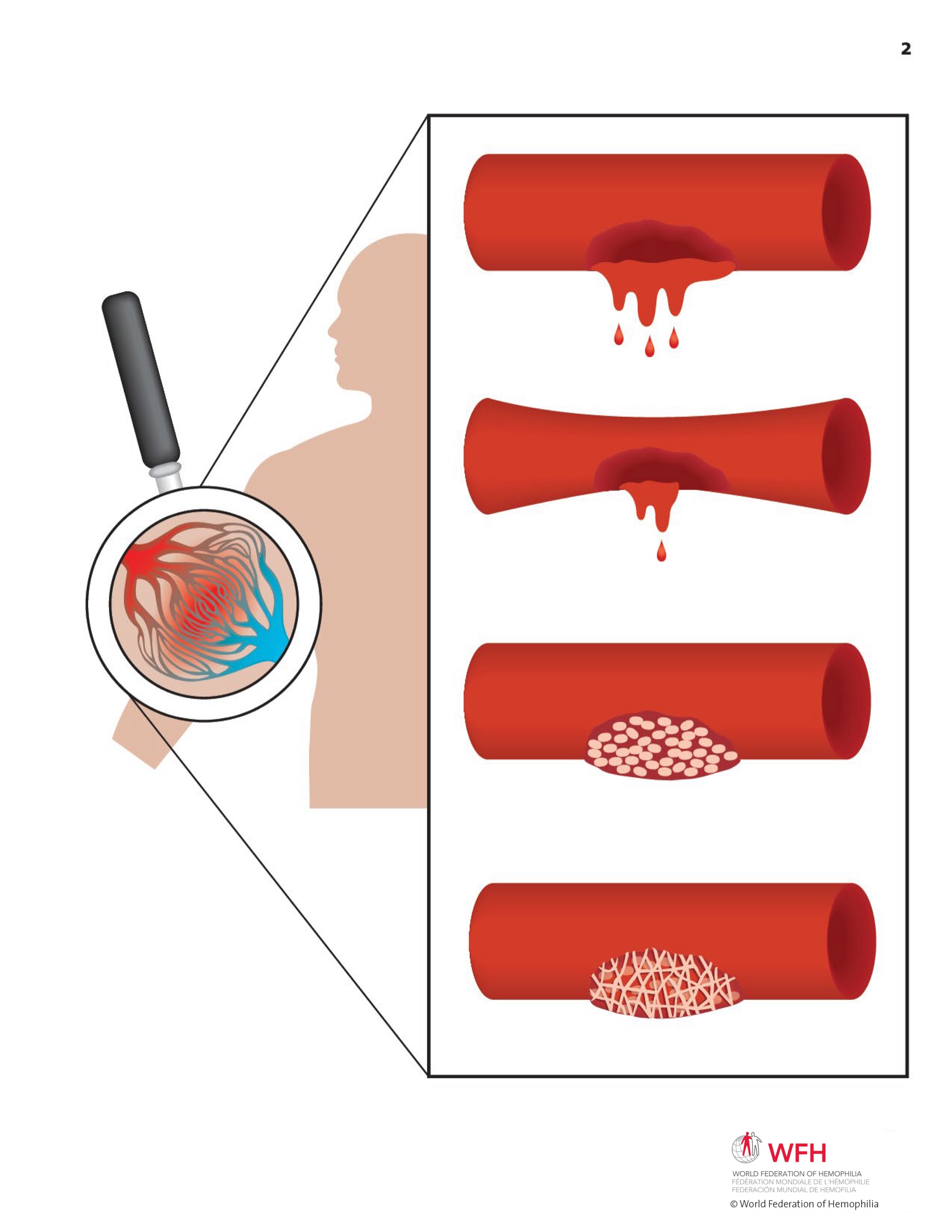 Hemophilia in Pictures spread